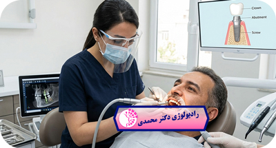 قبل از ایمپلنت دندان چه عکس‌هایی لازم است؟ راهنمای کامل تصویربرداری ایمپلنت | دکتر عباس محمدی مشهد